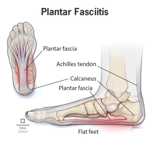 14709-plantar-fasciitis